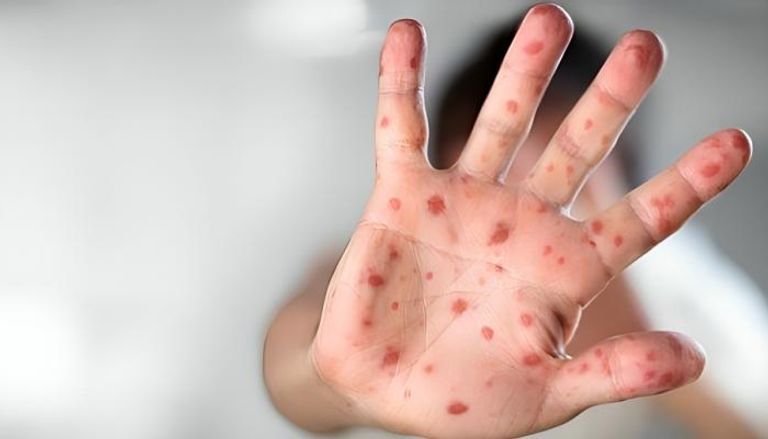 مرض الحصبة - تعبيرية