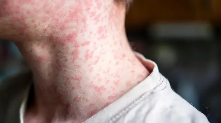 مرض الحصبة - تعبيرية