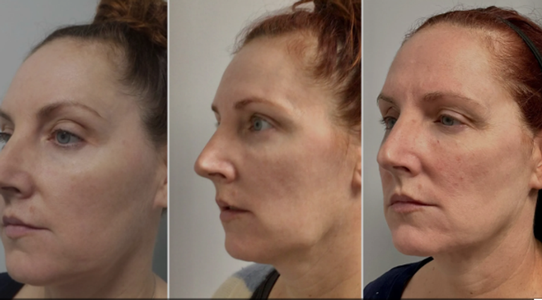 اتجاه جديد في عمليات التجميل