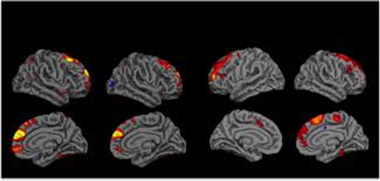 اكتشاف آلية جديدة لتعطيل "المثبط النفسي" في الدماغ