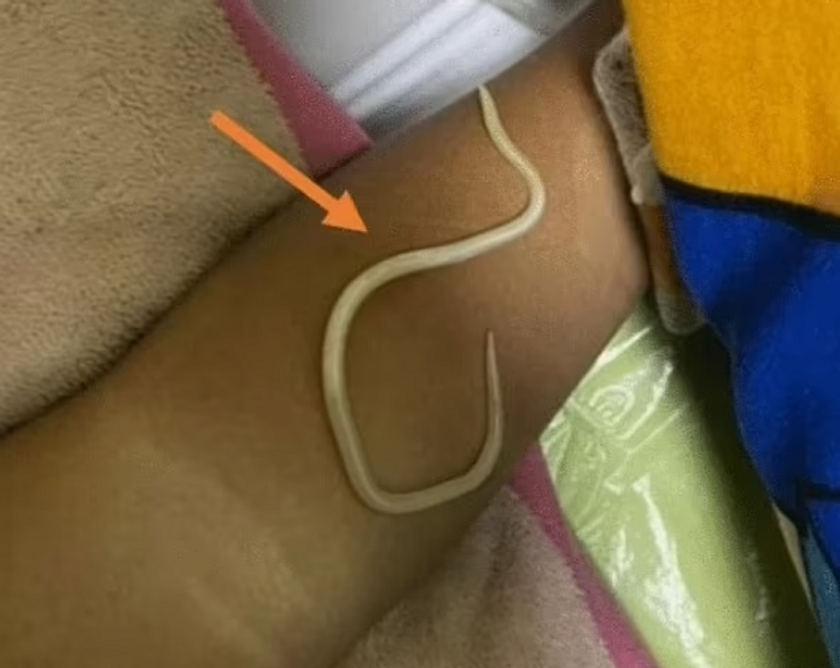 كمية كبيرة من الديدان العملاقة عزلت من جسد الطفل