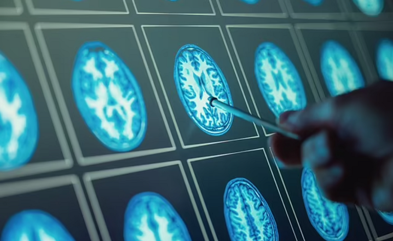 كوفيد طويل الأمد يهدد الذاكرة