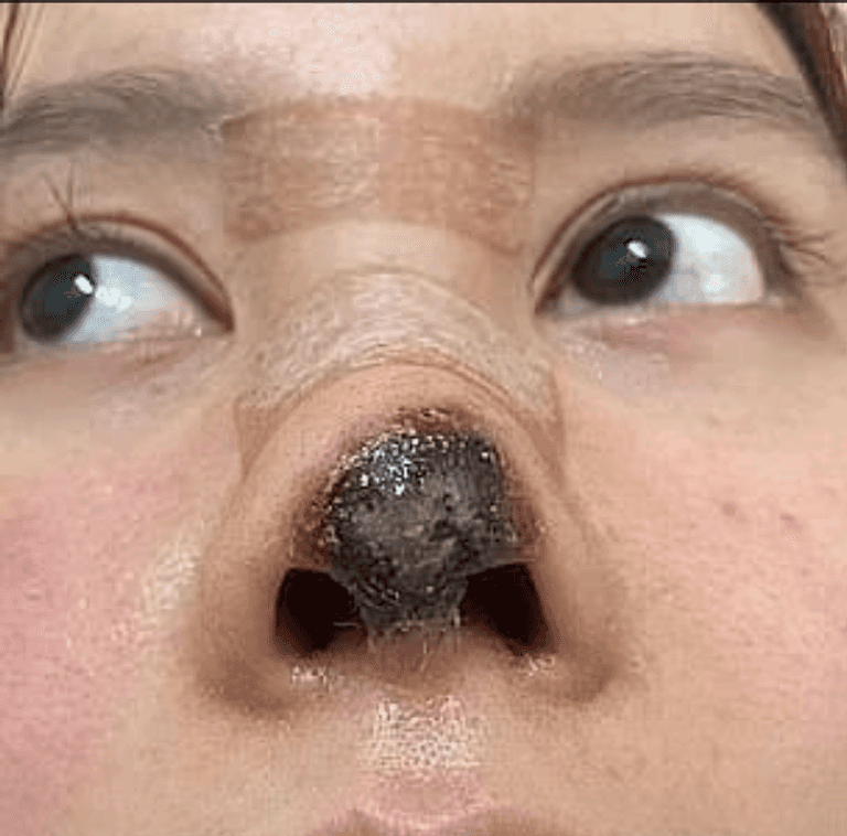 تحول طرف أنف النجمة الصينية غاو ليو إلى اللون الأسود