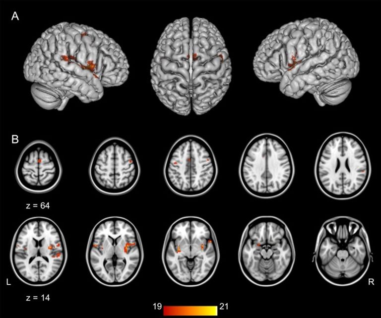 متلازمة اللكنة الأجنبية حالة صحية نادرة