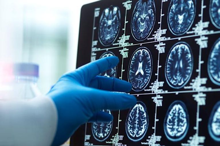 الإفراط في العمل لأكثر من 52 ساعة أسبوعياً يؤثر سلباً على بنية الدماغ