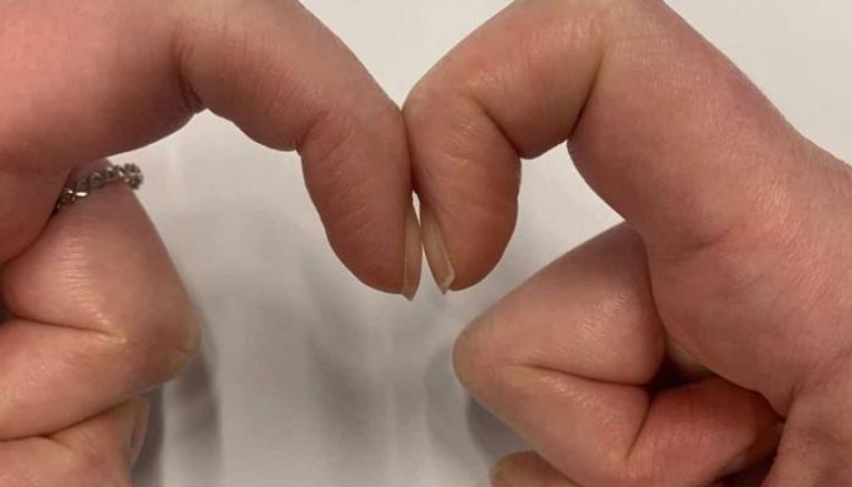 وجود الفتحة الصغيرة بين الأظافر مؤشر صحي وغيابها يدعو للقلق