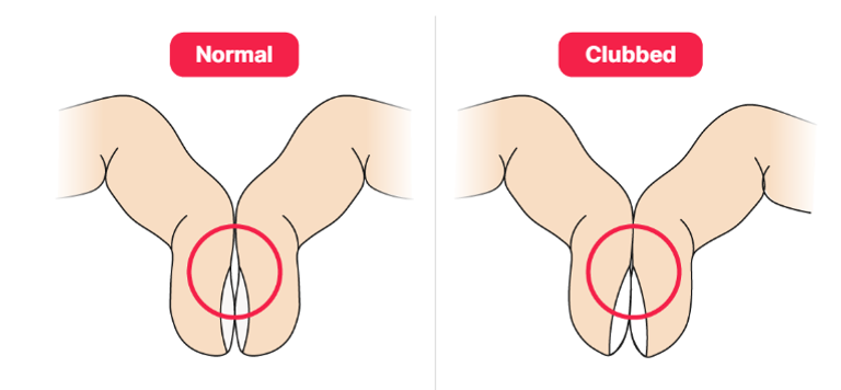 وجود الفتحة الصغيرة بين الأظافر مؤشر صحي وغيابها يدعو للقلق