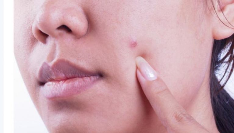 وجود بقعة تشبه الحبة وتستمر في النزيف والتقشر مشكلة لا يجب إهمالها