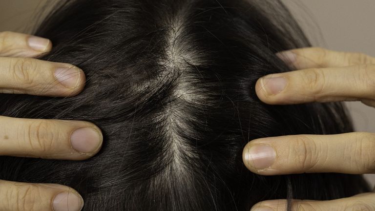 البقعة التي ظهرت في رأس ميكيلا بيكوك