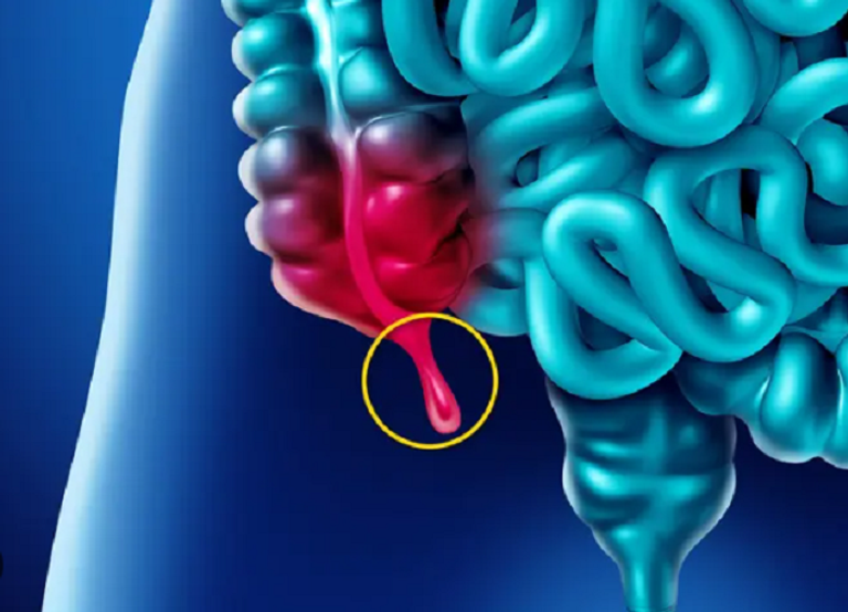 سرطان الزائدة الدودية مرض نادر وخطير يشهد ارتفاعا أسرع في أوساط الشباب