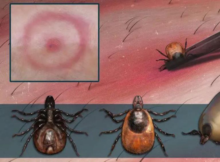 لدغات القراد تجتاح إسطنبول