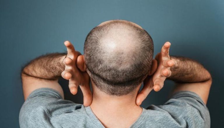 الرجال الصلعان في مرمى سرطان الجلد القاتل وسط موجة الحر الحارقة