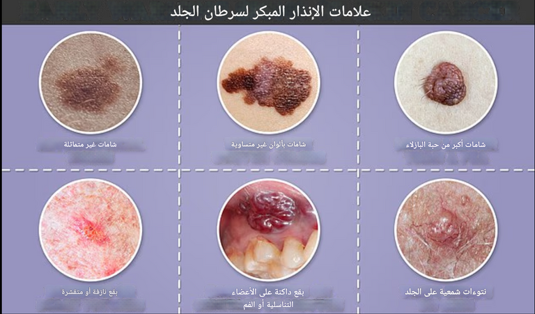 الرجال الصلعان في مرمى سرطان الجلد القاتل وسط موجة الحر الحارقة