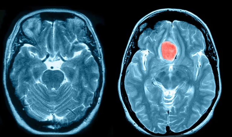 حقنة منع الحمل "ديبو-بروفيرا"