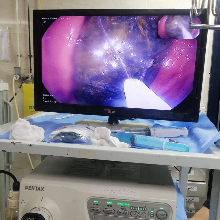 هاتف محمول في معدة مريض منذ عامين