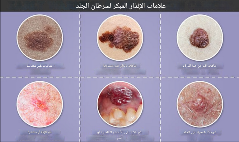 أطباء الجلدية طوروا  اختبارا تفاعليا سريعا لتشخيص سرطان الجلد