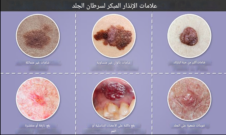 ليس كل سرطان ميلانوما بنيا أو أسود اللون كما يعتقد الكثيرون