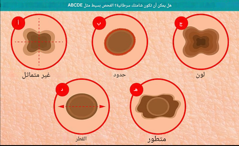 ذراع بلون بني داكن ومليئة بالتجاعيد والبقع بسبب إهمال الواقي الشمسي