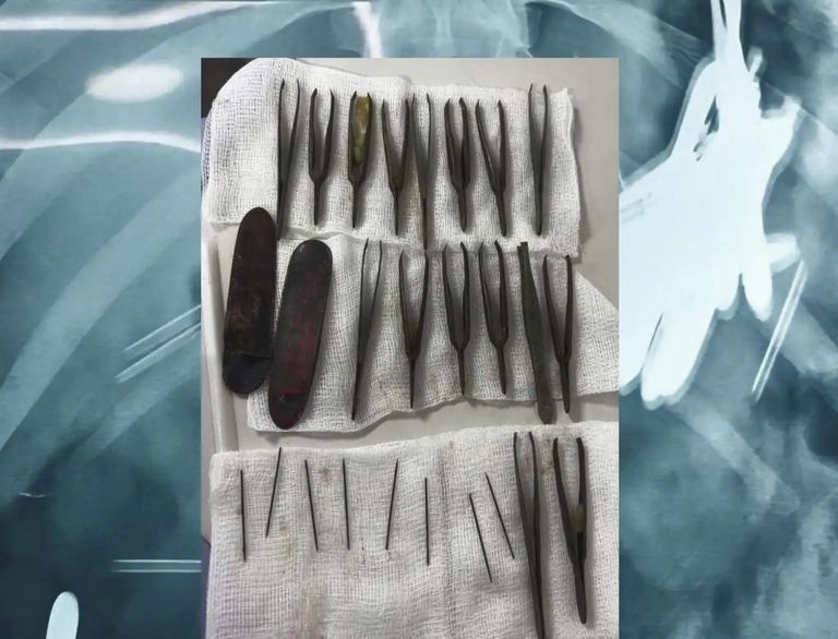 شاب يبتلع 24 أداة حادة