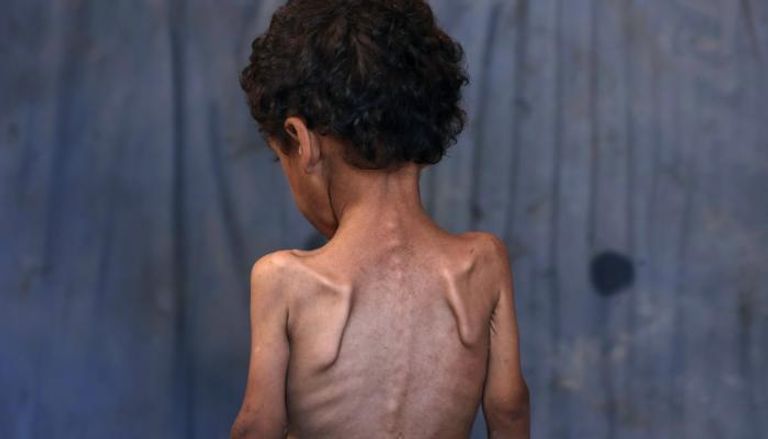 طفل في غزة يعاني من سوء التغذية