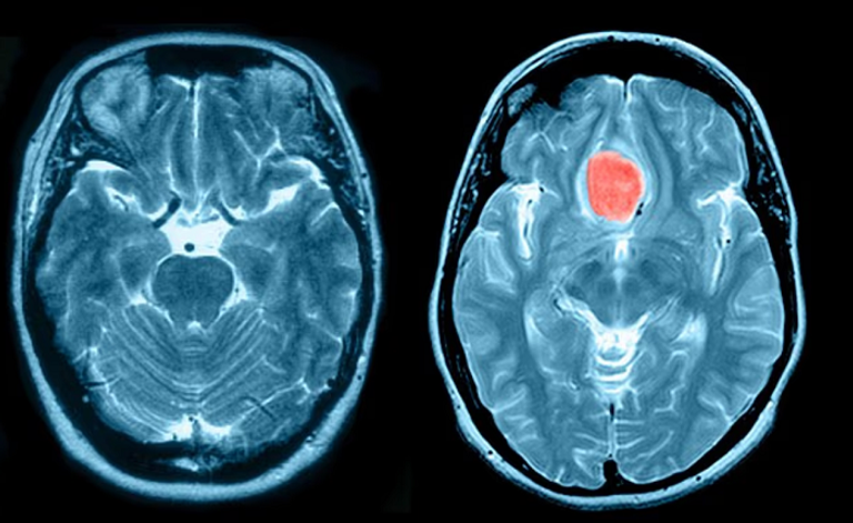 حقنة منع الحمل الشهيرة "ديبو بروفيرا" في مرمى الاتهامات 