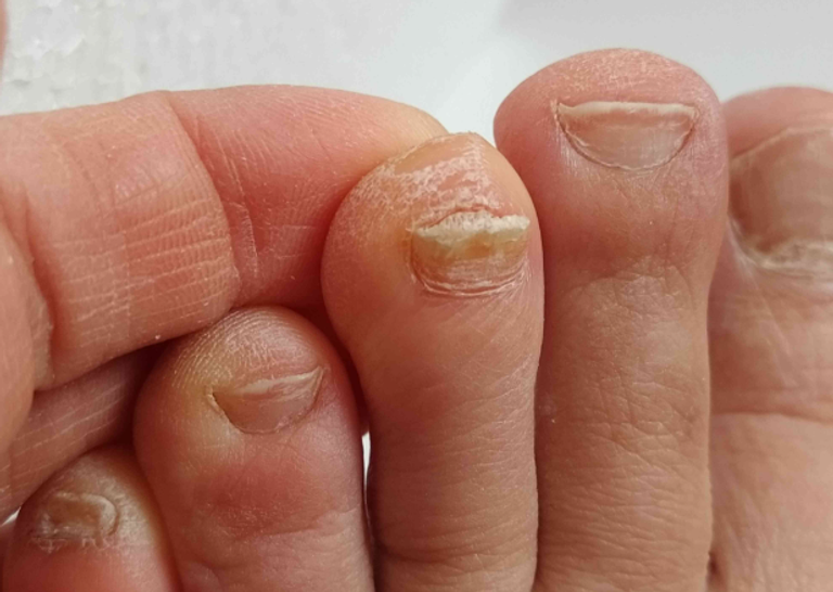 الدكتورة إيلي كانون قدمت نصائح للتعامل مع الأظافر الصلبة والقشرية