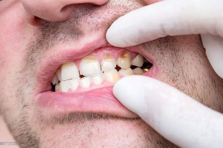 لون أسنانك يخبر بالكثير عن صحتك وشخصيتك