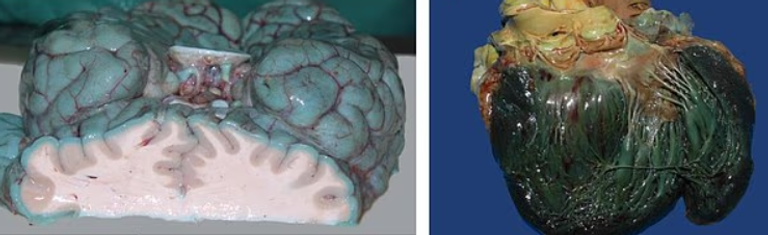 تحول أعضاء داخلية كالدماغ والقلب إلى لون أزرق غامض
