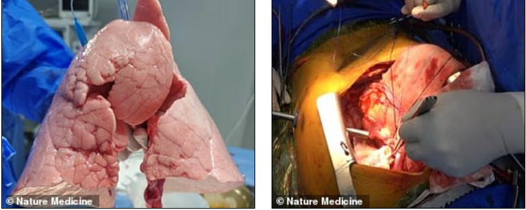 فريق طبي صيني أجرى أول عملية زراعة رئة خنزير معدلة وراثيًا في إنسان
