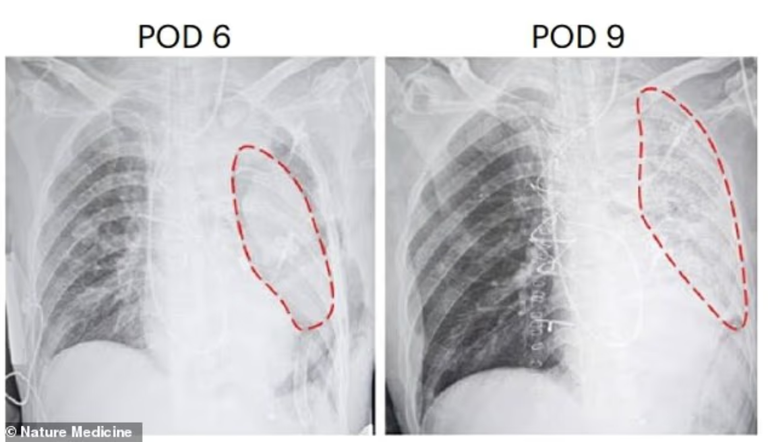 فريق طبي صيني أجرى أول عملية زراعة رئة خنزير معدلة وراثيًا في إنسان