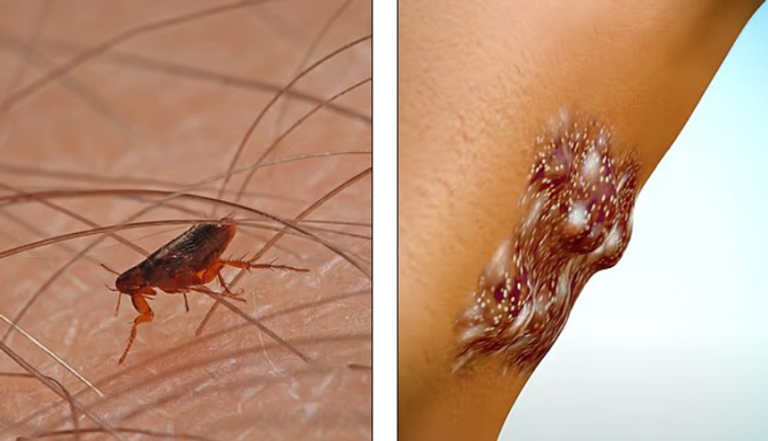 بكتيريا "يرسينيا بستس" المسببة للطاعون