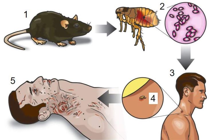 بكتيريا "يرسينيا بستس" المسببة للطاعون