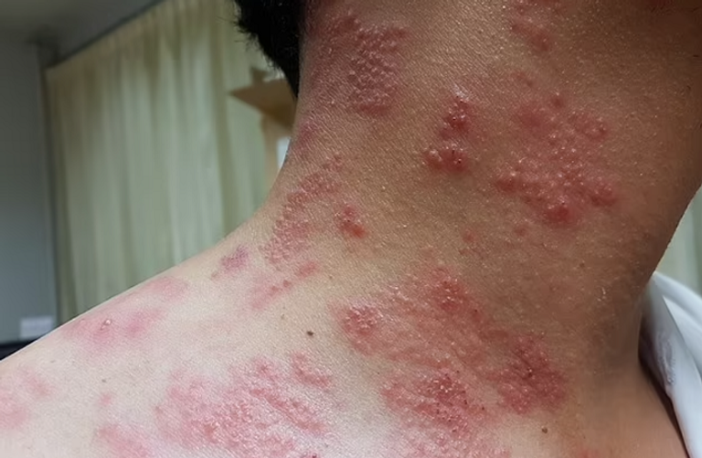 دراسة جديدة تؤكد أن لقاح الحزام الناري يحمي القلب والدماغ