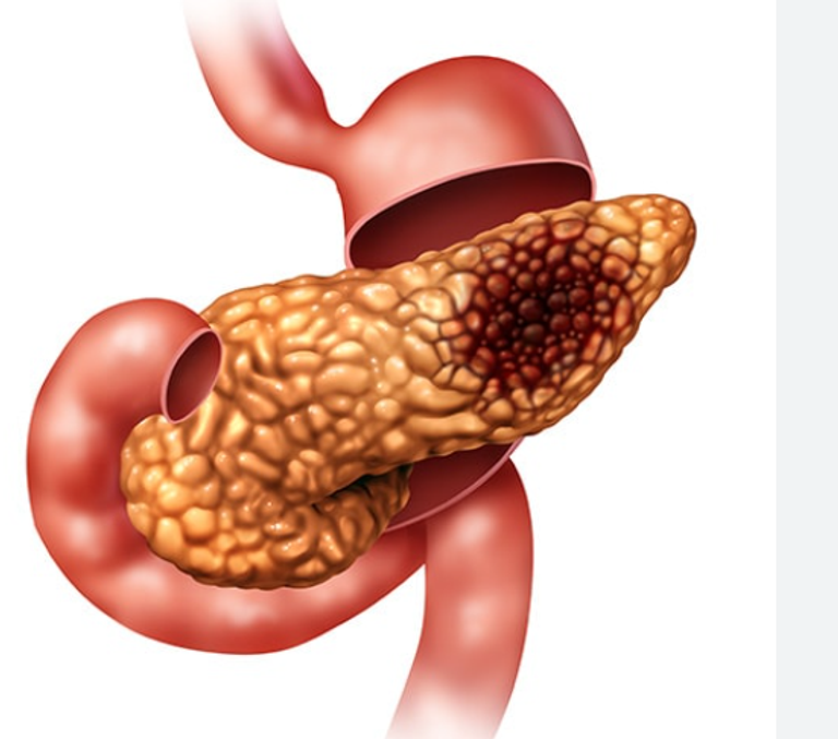 التدخين قد يزيد بشكل كبير من خطر الإصابة بسرطان البنكرياس