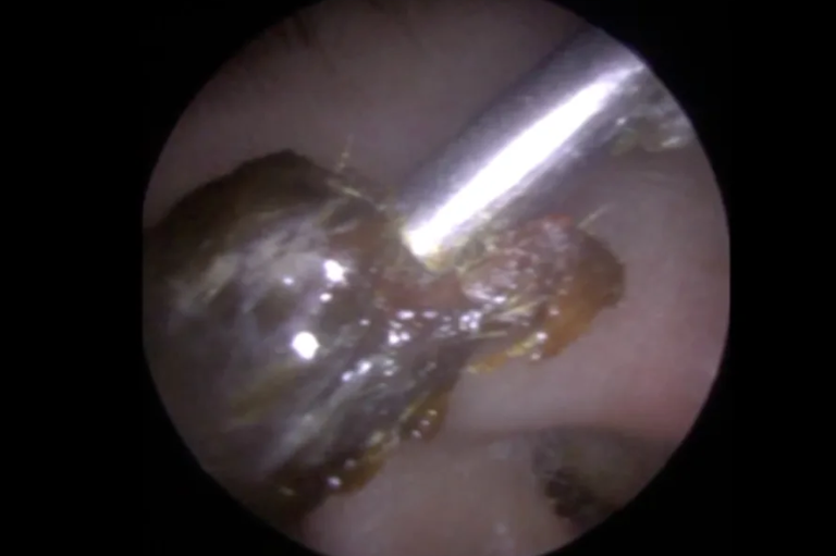 صورة للشمع المتراكم في الأذن