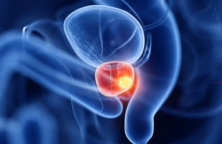 فحص جديد يكشف سرطان البروستاتا في 15 دقيقة فقط