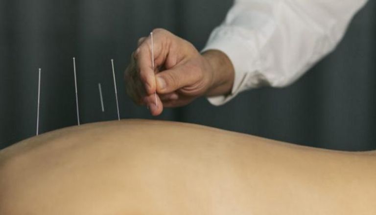 الوخز بالإبر يخفف آلام الظهر لعام كامل
