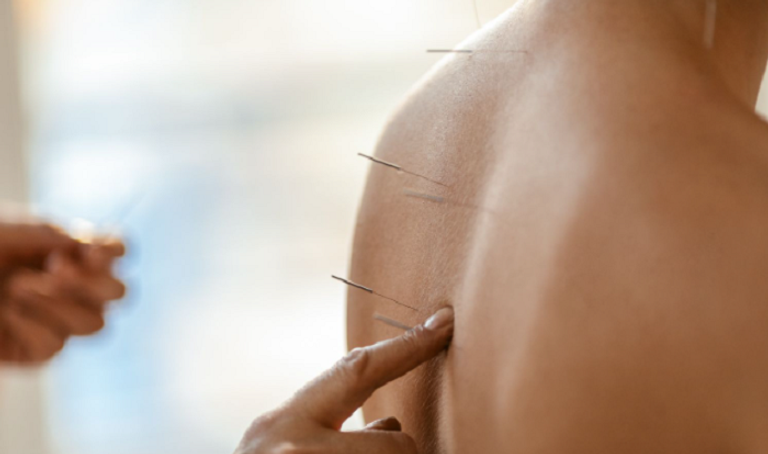 الوخز بالإبر يخفف آلام الظهر لعام كامل