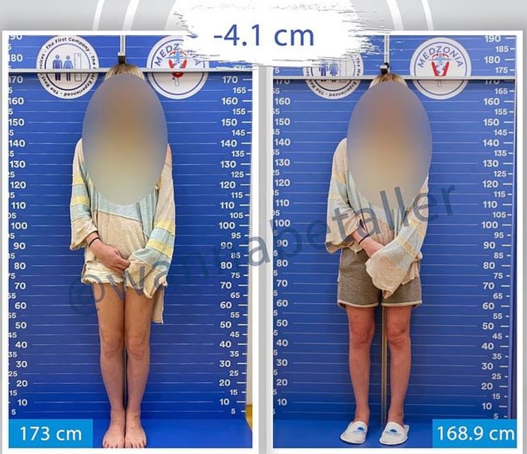 تقصير الساق- أرشيفية