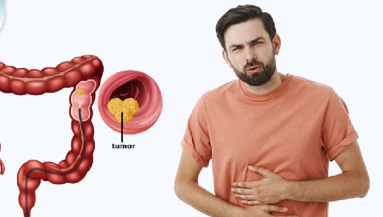 خمسة مؤشرات غير مؤلمة قد تنذر بسرطان الأمعاء