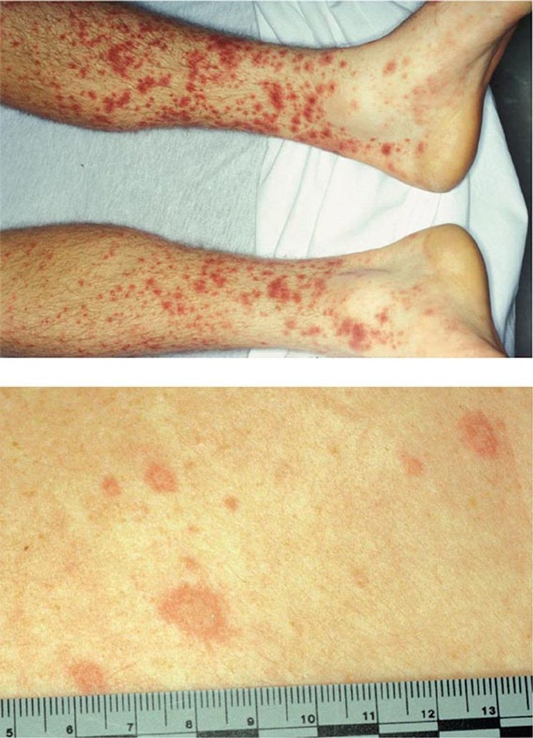 ليبتوسبيروز مرض بكتيري حاد