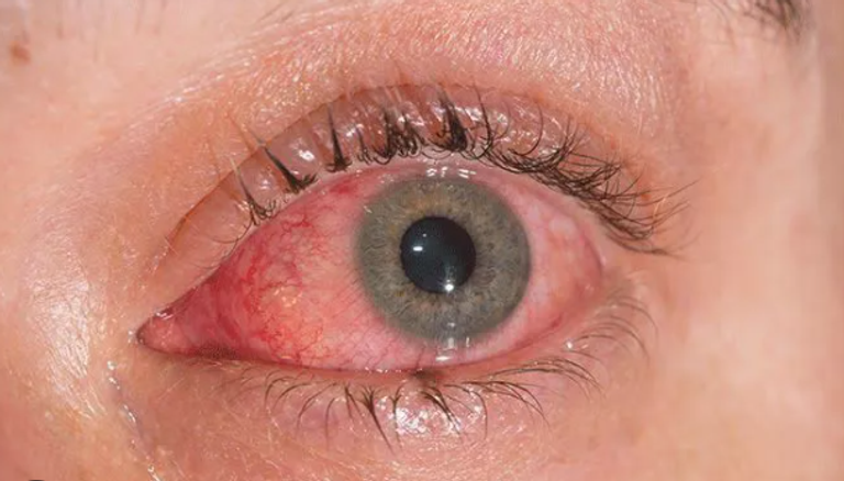 ليبتوسبيروز مرض بكتيري حاد