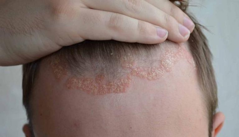 استخدام جرعات أعلى من دواء "ريسانكيزوماب" يمنع عودة الصدفية  