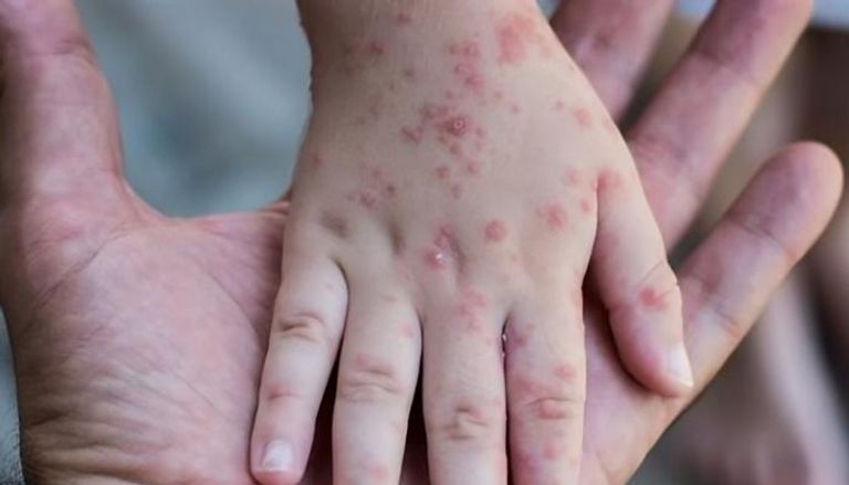 ارتفاع معدل إصابات بالحصبة في أمريكا