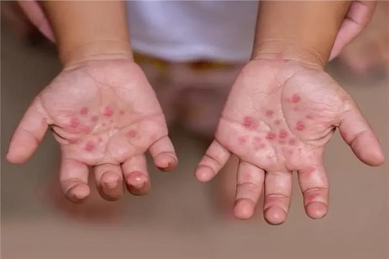 ارتفاع معدل إصابات بالحصبة في أمريكا