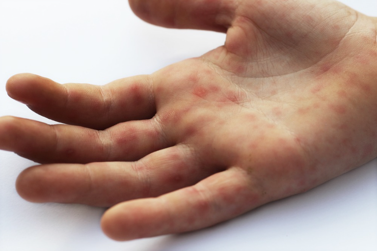 تسجيل ارتفاع حاد في عدد الإصابات بفيروس الحصبة بأستراليا