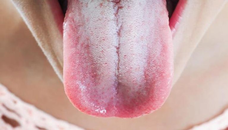 الذكاء الاصطناعي يكتشف السكري وسرطان المعدة من لون اللسان