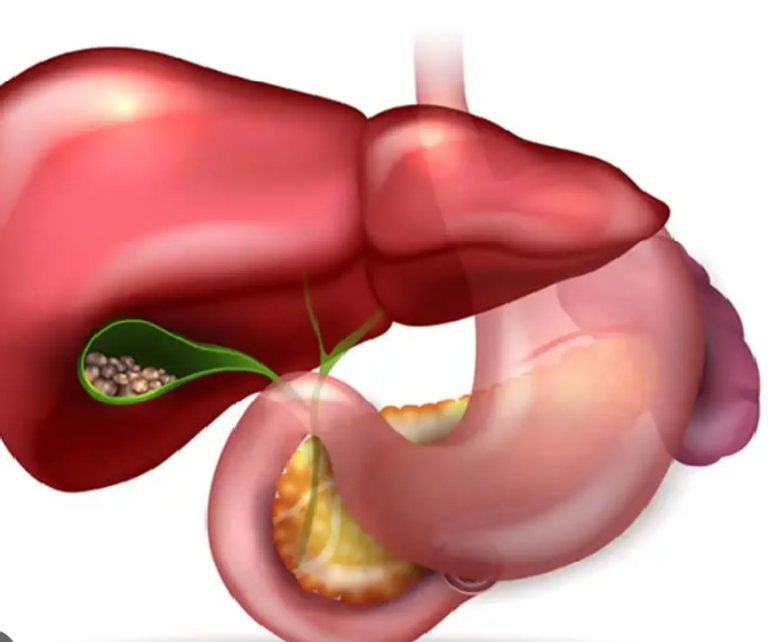 تقنيات الذكاء الاصطناعي تُظهر أداءً واعدا في تشخيص التهاب القنوات الصفراوية
