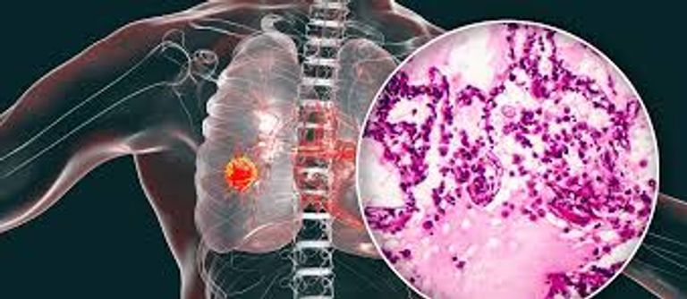 مركبا صغيرا تنتجه ميكروبات بالأمعاء يضاعف استجابة سرطان الرئة لعلاجات المناعة