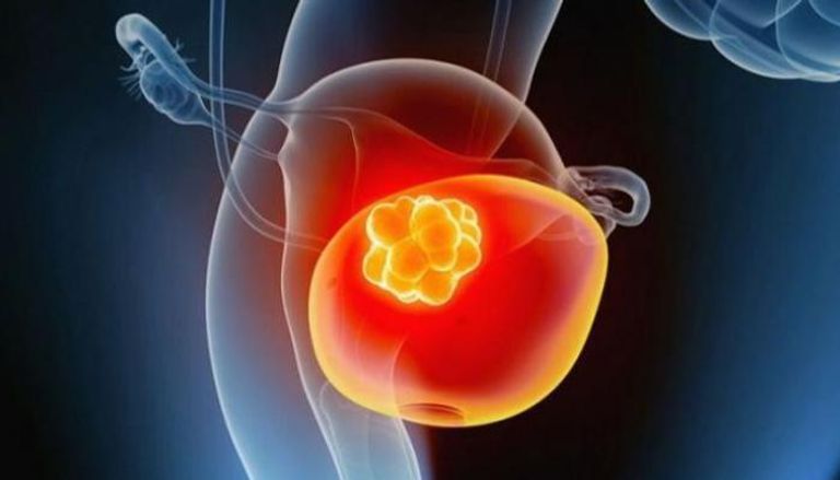 عمى الألوان يغيّب عن العين أول علامة تحذيرية لسرطان المثانة